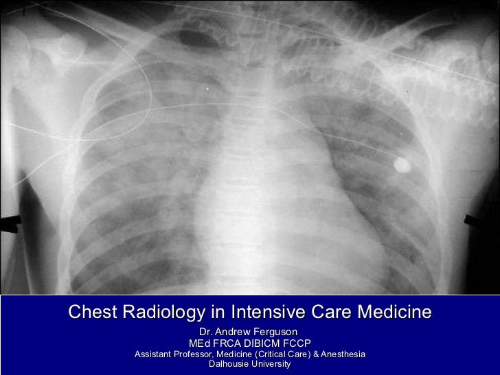 Pneumonia chest x-ray consolidating debt Pneumonia chest x-ray consolidating debt